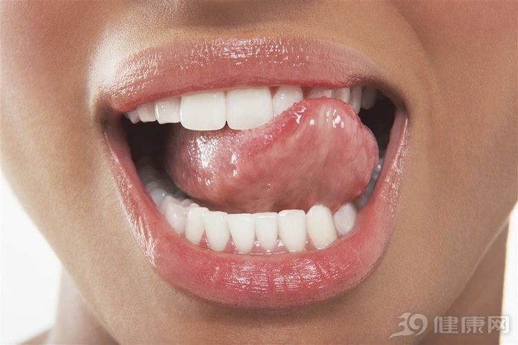 經常咬舌頭，可能與3種病有關，妳可能一個也不清楚