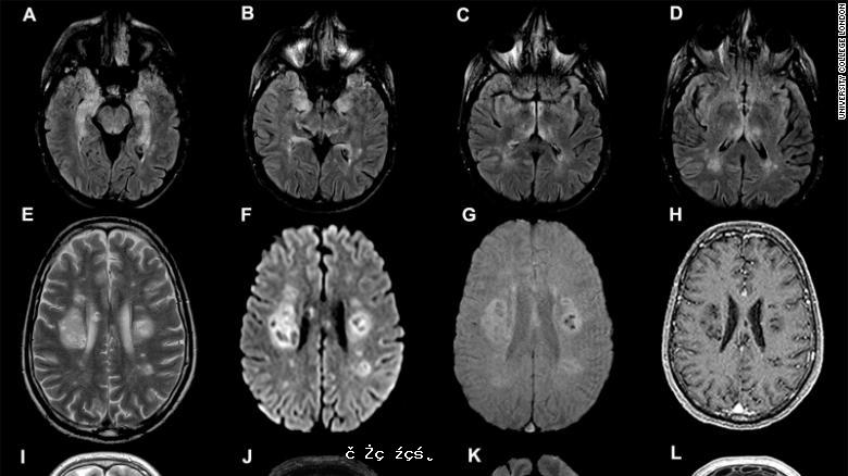 Brain：新冠疫情可能帶來大規模腦病患者