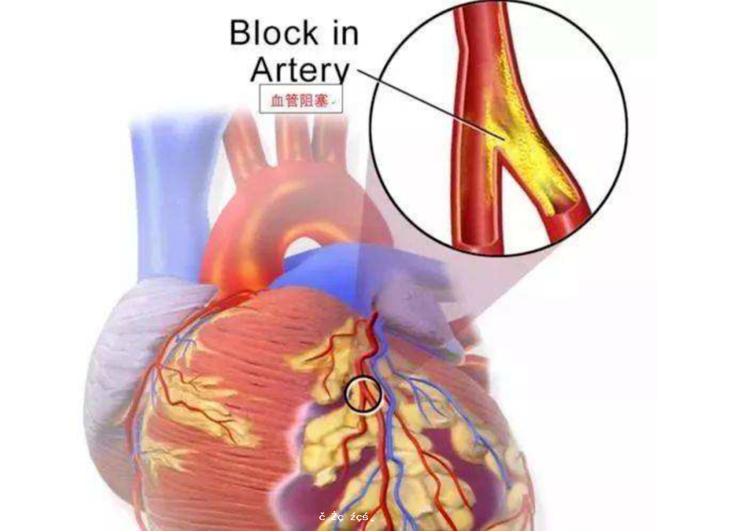 如何區分心絞痛和心梗？專家教妳“找不同” 