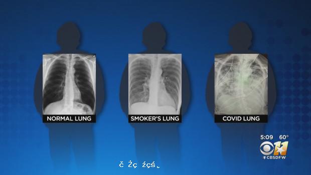 新冠病毒對肺部的損傷比長期吸煙更嚴重，可造成肺部結疤