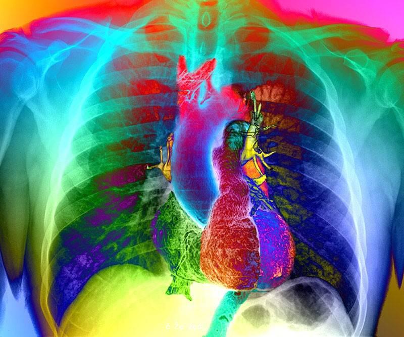 《自然醫學》：新冠肺炎康復後，20余種心血管疾病風險大幅提升 