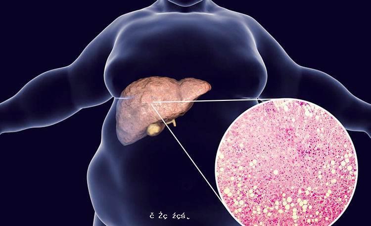 哪種脂肪肝易癌變？