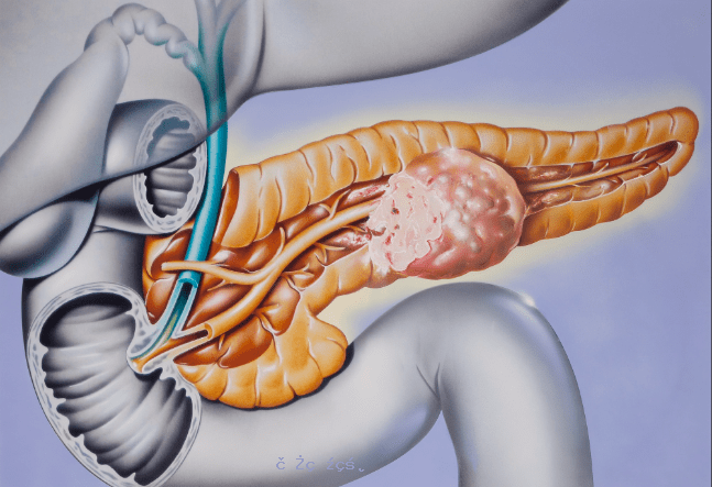 《胃腸病學》：青年女性胰腺癌發病率快速上升 